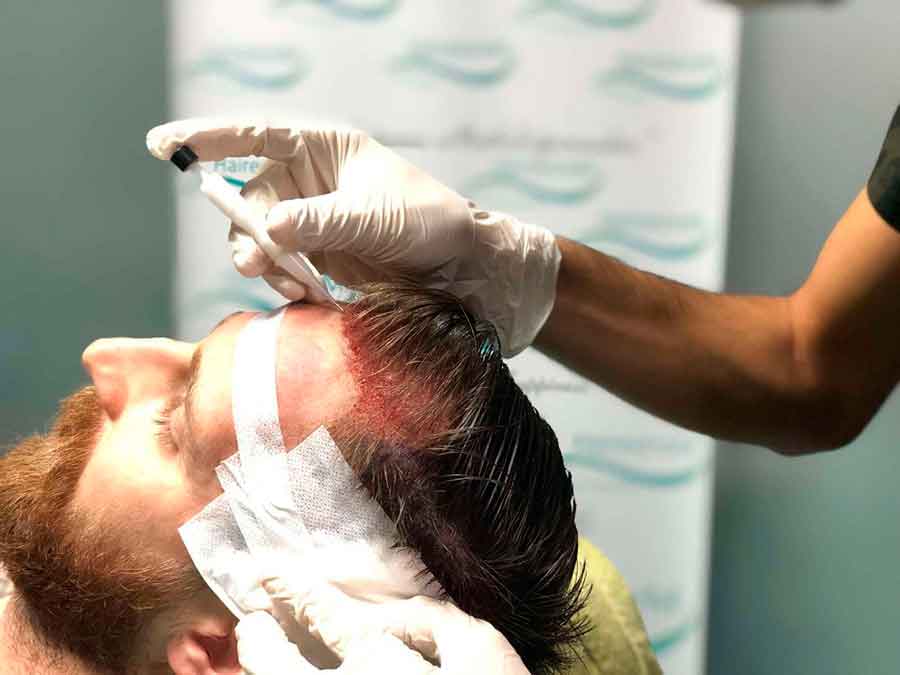 Пересадка волос в Турции